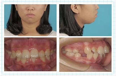 隐适美亚太讲师Dr.舒广 牙齿矫正拔牙与不拔牙病例分享
