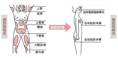 脂肪界导师研究假体隆胸取出那些并发症