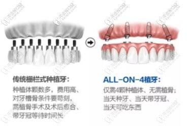 拔牙后能立即种牙吗 北京做种植牙好的这家口腔说出了真相