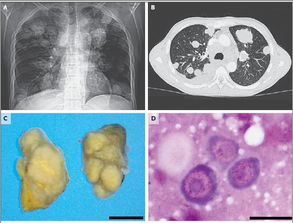 NEJM 绦虫感染竟成癌