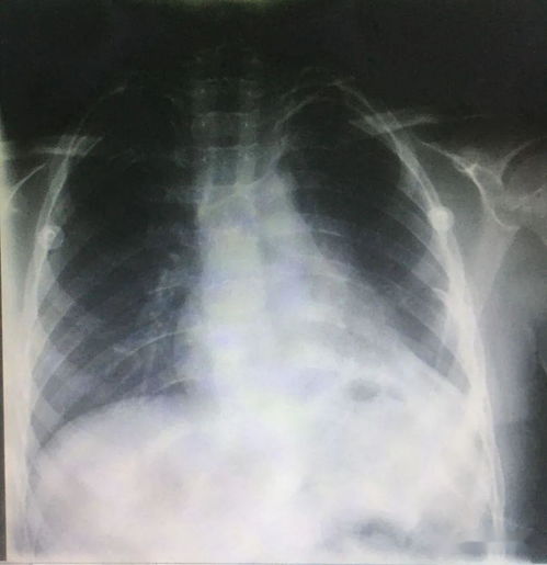 8岁儿童巨大肺囊肿,廊坊市四院微创切除