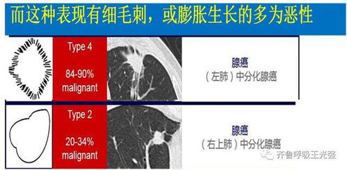 肺结节 ,别纠结 且看标准处理流程是这样的