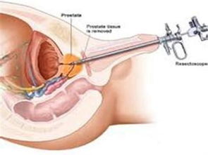 前列腺钙化灶声像 斗图表情包大全 - 与 前列腺