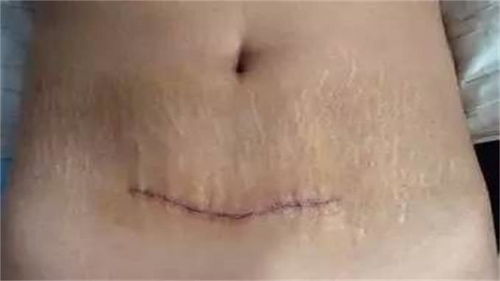 剖腹产后的疤痕 剖腹产的刀疤一般多久会彻底恢复