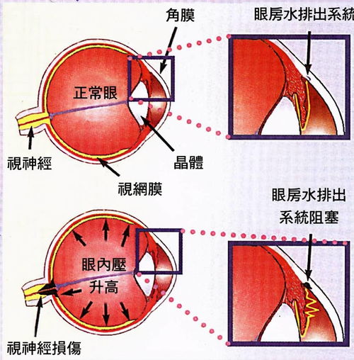 想用降眼压的眼药水来增长睫毛 建议你先看看这篇文章