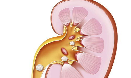 2cm肾结石怎么处理 如果不想手术用这方法,根除结石不是难事