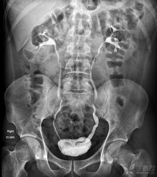 输尿管囊肿 Ureterocele