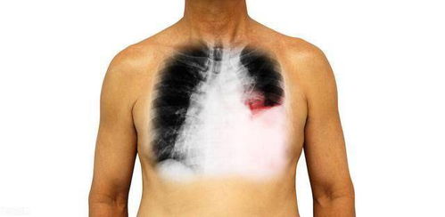 肺内生水就是肺癌 大部分不是,除非水中找到癌细胞,症状有哪些