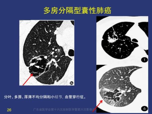 囊腔性肺癌如何诊断 空洞性肺癌