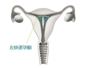 曼月乐避孕环 曼月乐环有什么作用与功效影响身体吗