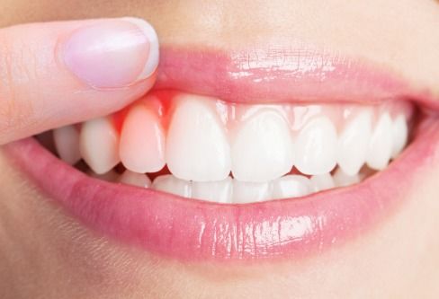 孕产小百科 孕妇牙龈出血的原因和症状