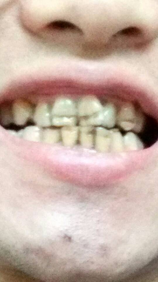 1 我有几颗牙齿的外面有横向的凹槽 门牙在中间,有的接近牙尖 虎牙 ,还是黄的 小时候牙齿就这样 