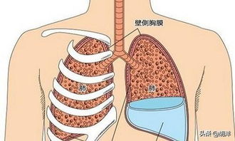 肺积液抽液手术大吗