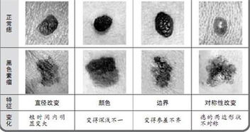 头皮黑色素瘤早期图片 搜狗图片搜索