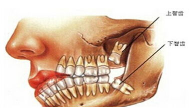 长智齿有什么危害 