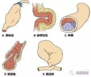 胃肠道急腹症丨必须搞清楚的几个问题 