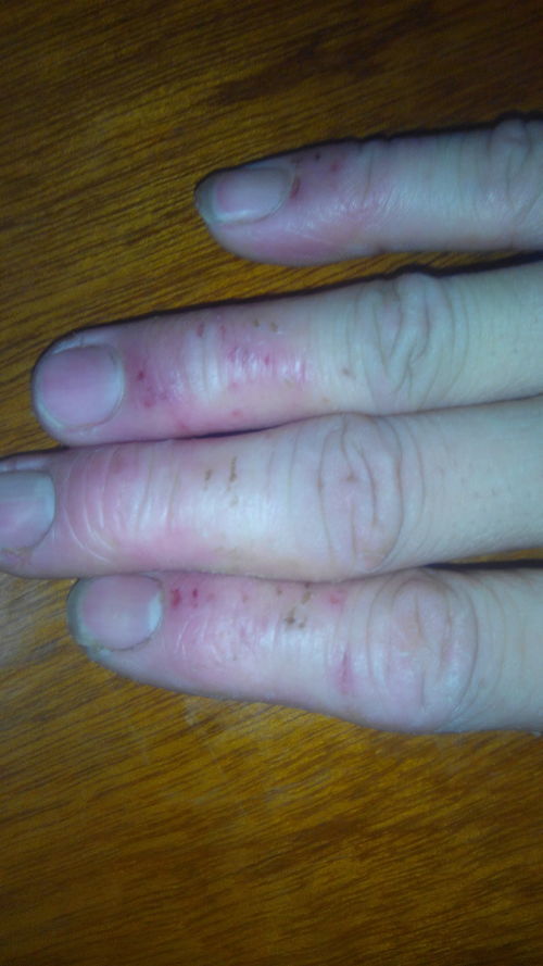 手指头长了小水泡不抓就不会痒 可是抓破了就痒又脱皮 请问这是什么皮肤病啊 应该怎么治疗呢 