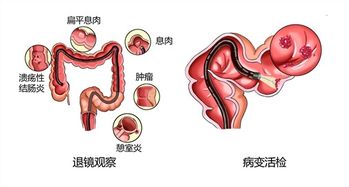 结肠镜检查步骤