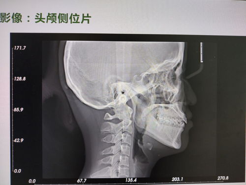 记录28岁正畸,陶瓷自锁托槽整牙历程 