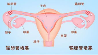 哪种情况下输卵管堵塞需要进行试管婴儿治疗