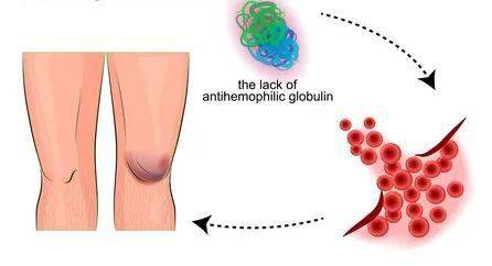 血友病不只是凝血功能障碍 这些症状不能忽视