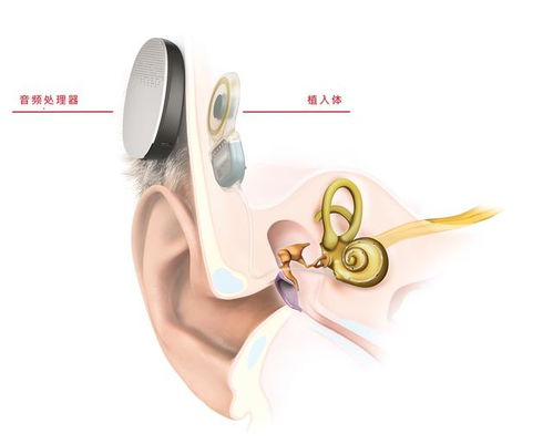 欧洲首例全植入人工耳蜗手术