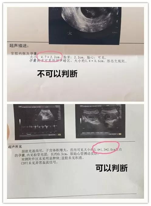 孕囊形状看男女(超准) 孕囊看男女几周最准确,看早期孕囊形状看男女准吗