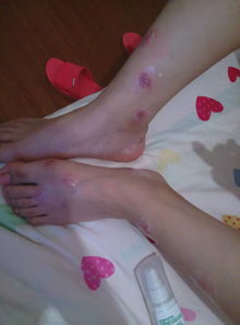 只有小腿和脚上有 大红疙瘩硬的 上面有水泡 很痒 疙瘩旁边肿了 图片是我姐的 我的没那么严重 家住 