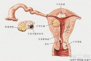 子宫内膜癌手术后应该注意什么