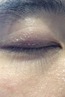 下眼睑过敏怎么弄好看 眼睛下眼皮老是红肿，情况是由于过敏反应所致的吗