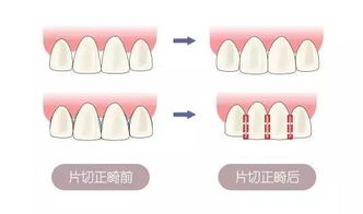 牙齿矫正 牙齿拥挤怎么办 3招就搞定