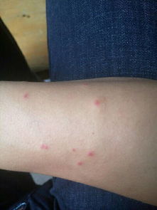 手臂上长了很多这种红痘痘是怎么回事 