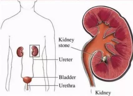 当心小石头变成大隐患,肾结石越小治疗越好