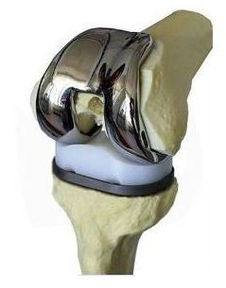 人工全膝关节置换术是什么