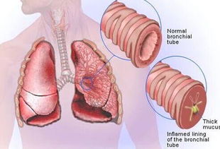支气管肺炎吃什么食谱 -图2