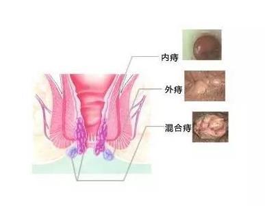 痔疮红肿疼痛怎么办,了解痔疮红肿疼痛的原因