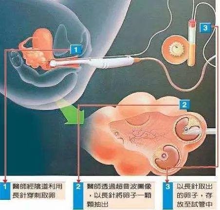 还在纠结试管婴儿疼不疼 别怕,七个环节告诉你答案