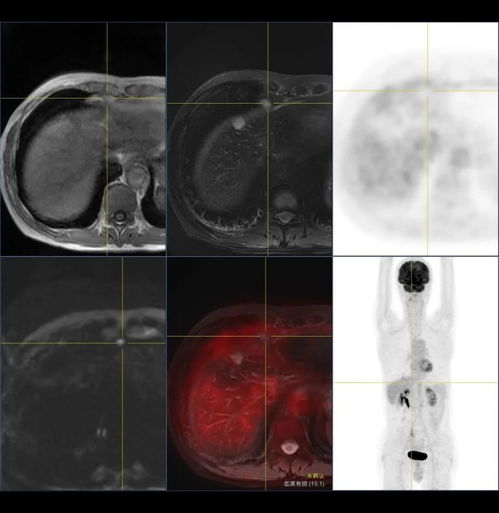 为什么医生不建议做pet-ct