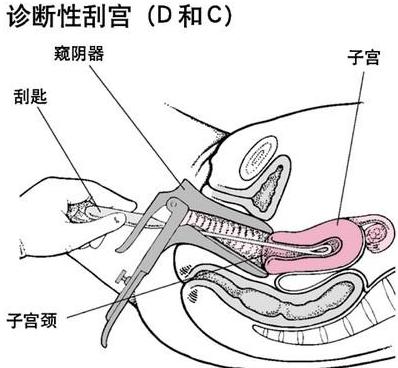 不做人流,为什么要刮宫 刮宫和人流是一样吗 