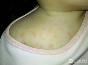湿疹是什么原因引起的 湿疹是怎么引起的