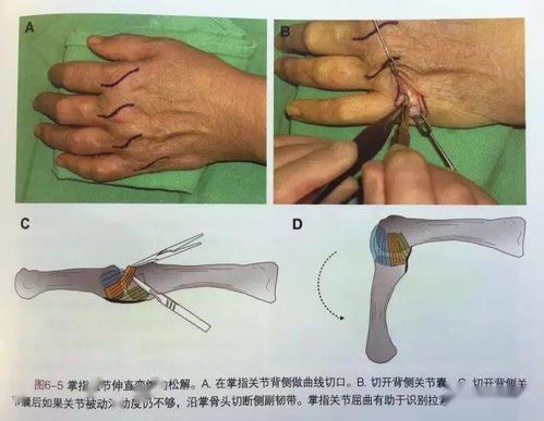 手指关节卡住不能动,是怎么回事