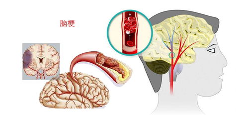 脑梗前兆及如何预防