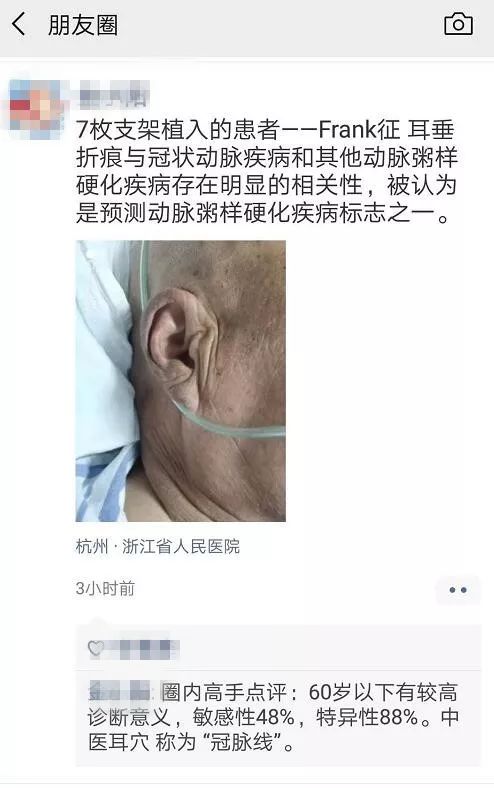 杭州大伯耳垂有明显折痕,老伴听老姐妹说这是病,去医院一查还真不骗人