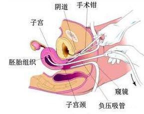 宫腔镜下格蕾丝无痛保宫取残留术 不伤宫 取残留