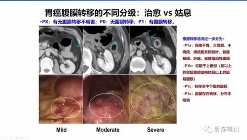 肿瘤大咖谈 沈琳教授实例讲解8大特殊类型胃癌的综合治疗