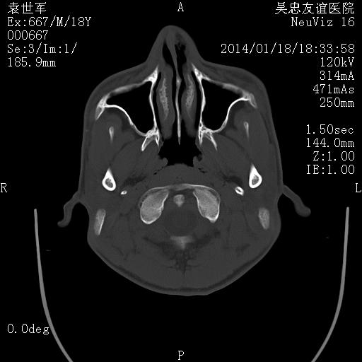 影联网 鼻骨骨折 