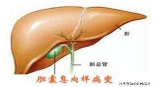 胆囊息肉保胆治疗方法是什么