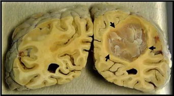 脑肿瘤的晚期症状是什么(脑肿瘤晚期可以治愈吗)