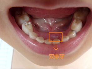 那些关于宝宝牙齿的注意事项,你知道几个 