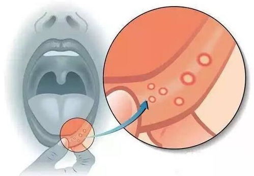 口腔溃疡经常反复发作,可能跟这6个因素有关,还请及时调理